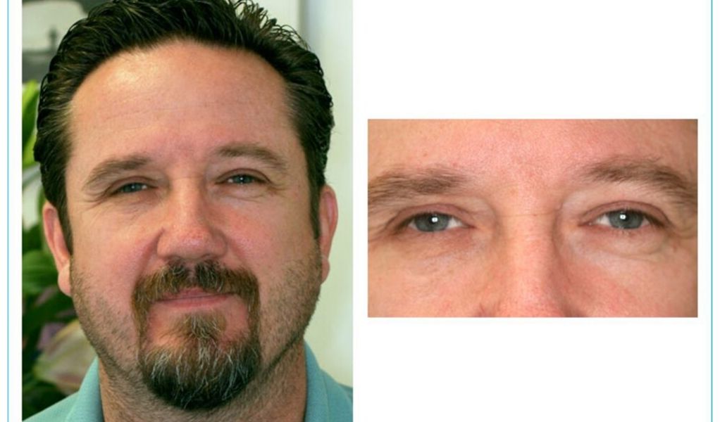 The emotional benefits of receiving an eye implant#2