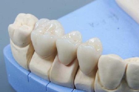 Bridgeworks In Dental Prosthetics